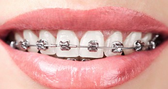 CLEAR BRACES – Welcome To Lana's Dental Care (239) 593-6488